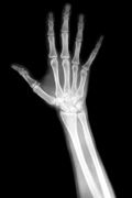 X-ray of a person's hand