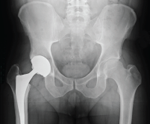 X-ray of the pelvis and hips